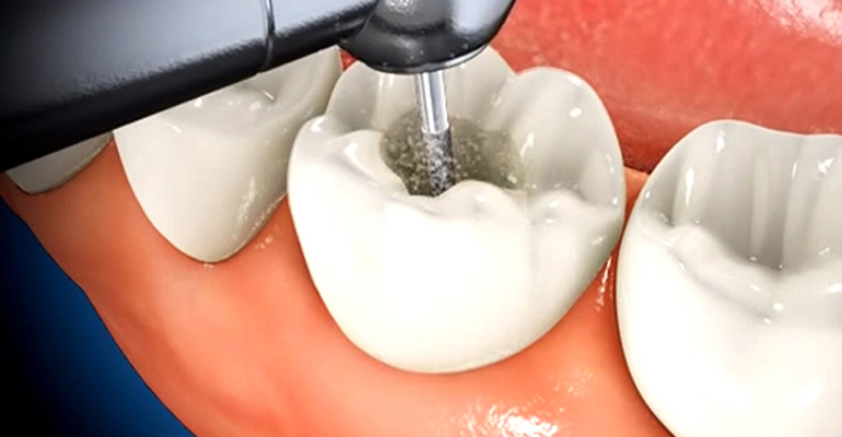 Root Canal Treatment