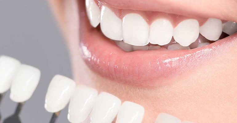 Teeth Whitening in Mumbai